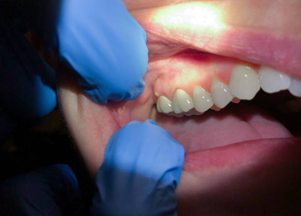 Best Urgent Care for Lost Fillings or Crowns in Goulds, FL